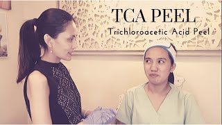 TCA Peel for Acne Scars Trichloroacetic Acid Peel [upl. by Aivataj]