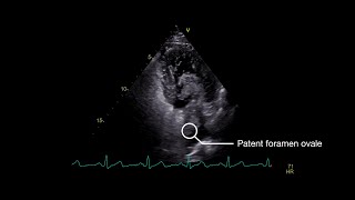 Stroke From Paradoxical Embolism Through a Patent Foramen Ovale [upl. by Adekan]