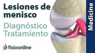 😩😩ROTURA DE MENISCO ► Diagnóstico y tratamiento de fisioterapia médico y quirúrgico [upl. by Alliuqaj497]