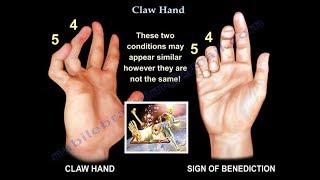 Claw Hand Ulnar Claw Hand  Everything You Need To Know  Dr Nabil Ebraheim [upl. by Drofub]