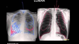 Pneumonia Imaging [upl. by Naegem681]