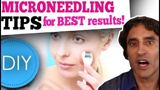 MICRONEEDLING DIY at HOME  What You Need to Know [upl. by Jenine]