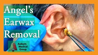 Angels Earwax Removal  Auburn Medical Group [upl. by Naquin]