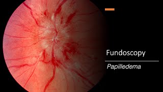 Papilledema Fundoscopy [upl. by Baniaz]