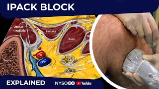 IPACK Block  Regional anesthesia Crash course with Dr Hadzic [upl. by Petey]