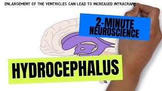 2Minute Neuroscience Hydrocephalus [upl. by Wilser43]