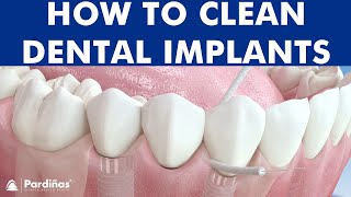 Dental floss and waterfloss  How to clean dental implants © [upl. by Keung]