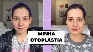 MINHA OTOPLASTIA Antes e depois pós operatorio e preços [upl. by Ketti238]