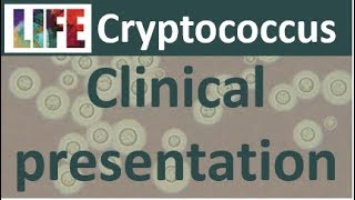 Cryptococcosis clinical presentation [upl. by Yrocej234]