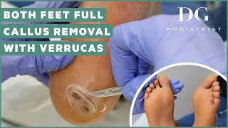 Callus removal from feet both feet and three verruca plantar warts treatment [upl. by Assirrak164]