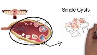 Ovarian Cysts Symptoms Complications amp Treatments  Pearl Womens Center [upl. by Leesa]