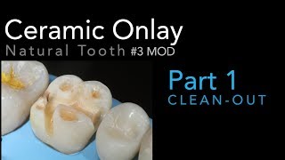 Lithium Disilicate Ceramics Part 1 Ceramic Onlay CleanOut 3 MOD [upl. by Arteid]