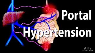 Portal Hypertension Animation [upl. by Amo]