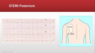 ECG Base Ischemia  Quiz FOAMed [upl. by Frederique]