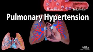 Pulmonary Hypertension Animation [upl. by Spenser328]