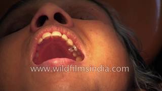 Root Canal treatment in India [upl. by Dehlia]