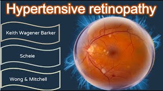 Hypertensive retinopathy simplified [upl. by Eniloj]