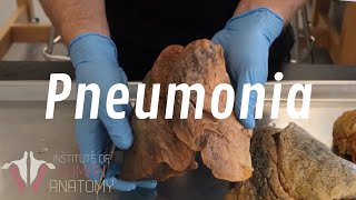 What Is Pneumonia [upl. by Semela]