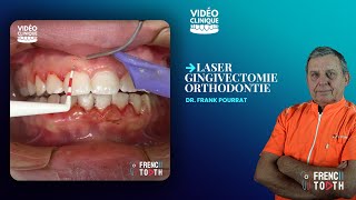 Laser gingivectomie orthodontie  Dr Pourrat [upl. by Aihcsrop]