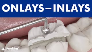 Dental inlays and onlays © [upl. by Noterb]