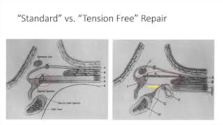 Literature Review The tensionfree hernioplasty Lichtenstein repair [upl. by Essirahc]