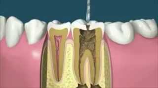 How to Do Root Canal Treatment [upl. by Munniks]