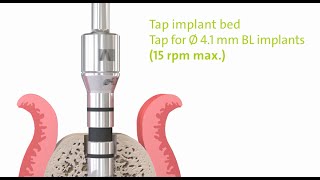 Straumann® PURE Ceramic Implant Monotype Step by Step [upl. by Eidahs517]