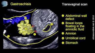 Gastroschisis [upl. by Otreblada]