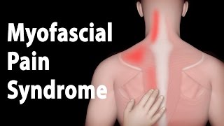 Myofascial Pain Syndrome and Trigger Points Treatments Animation [upl. by Anilehs741]