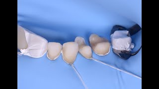 Multiple OnlaysVeneers adhesive cementation [upl. by Button]