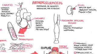 Atherosclerosis  Pathophysiology [upl. by Asnerek904]