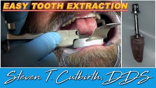 Easy Tooth Extraction  Dental Minute with Steven T Cutbirth DDS [upl. by Elik]