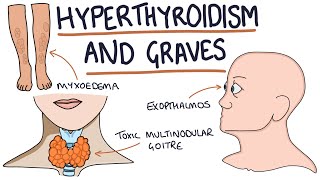 Understanding Hyperthyroidism and Graves Disease [upl. by Naihtniroc410]