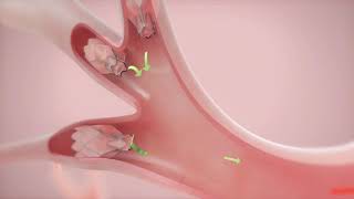 How It Works Zephyr Valve Treatment for COPD amp Emphysema [upl. by Goddord]