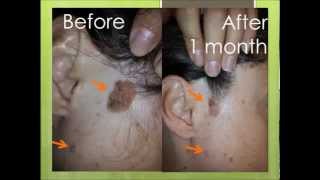 Natural treatment for seborrheic keratosis before and after photos [upl. by Hanson438]