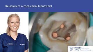 Revision of a root canal treatment [upl. by Eyahs541]