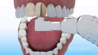 CARILLA DENTAL estética anterior  Video 3D paso a paso [upl. by Yerahcaz]