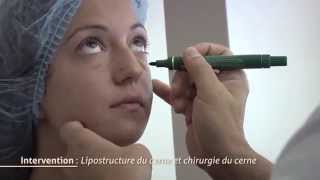 Chirurgie des cernes  Lipostructure du cerne [upl. by Tamar]