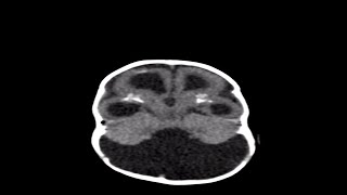 How Genetic Defects Cause Microcephaly [upl. by Airebma]