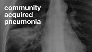 Community Acquired Pneumonia [upl. by Marisa]