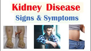 Kidney Renal Disease Signs amp Symptoms ex Peripheral Edema Fatigue Itchiness [upl. by Aluap]