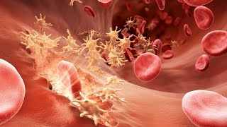 Understanding Hemophilia [upl. by Kenward127]