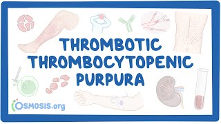 Thrombotic thrombocytopenic purpura NORD [upl. by Illona]