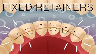 All About Fixed Retainers [upl. by Ettennan]