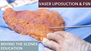 The Science Behind Vaser Liposuction How Does It Work [upl. by Atelahs770]