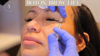 Botox Brow Lift [upl. by Polky]