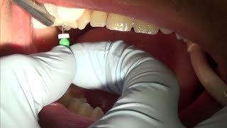 root canal treatment part 1 [upl. by Oinimreh]