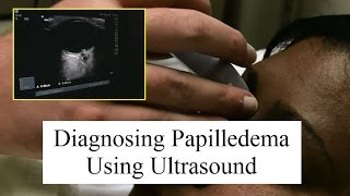 Using Ultrasound to Diagnose Papilledema [upl. by Eutnoj]