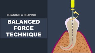 Balanced Force Technique  Cleaning and Shaping [upl. by Ieppet]