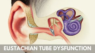 What is Eustachian Tube Dysfunction [upl. by Schnorr625]